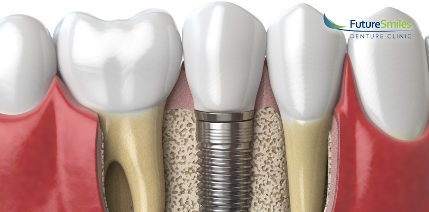 Calgary Dental Implants